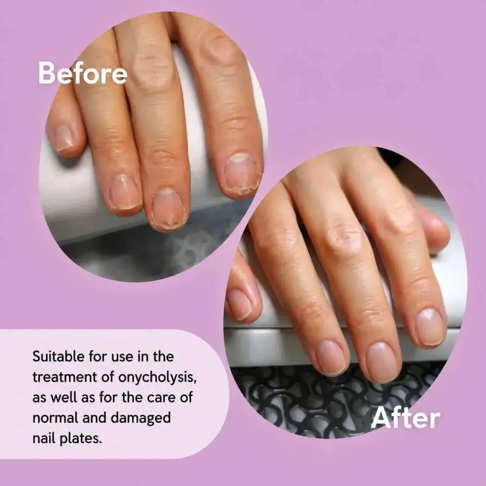 Shelly Stop Onycholysis Nail Oil 30ml